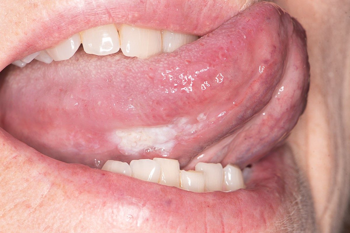 Leukoplakia, or white patch, of the bottom right side of the tongue. Pre-cancerous growths often present in this way.